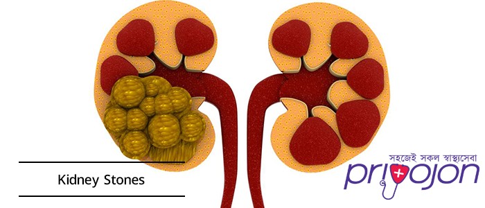 kidney-stones-symptom-causes-treatment-diet-and-removal