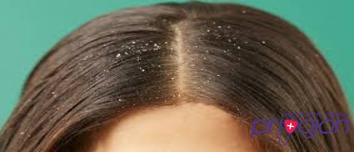 dandruff-causes-symptoms-treatment-and-home-remedies