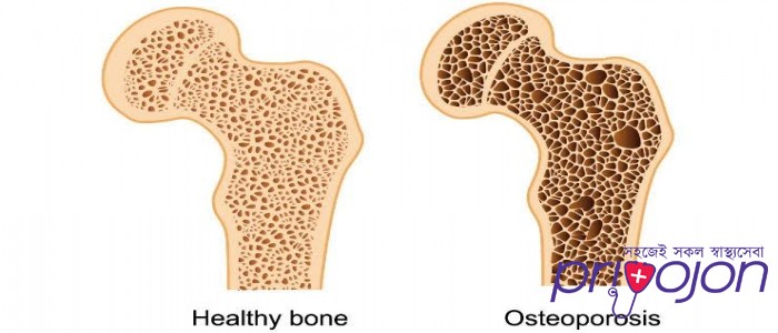 osteoporosis-symptom-treatment-and-causes