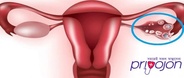 ovarian-cysts-treatment-procedure-cost-and-side-effects