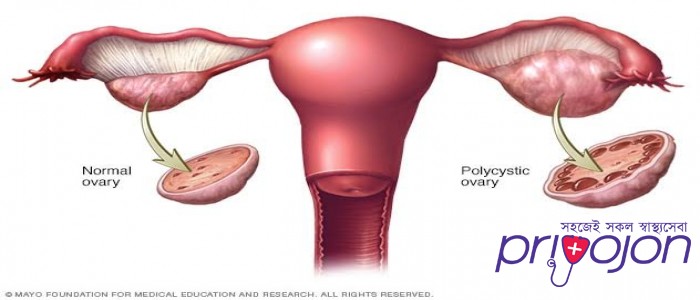 pcos-symptom-treatment-and-causes