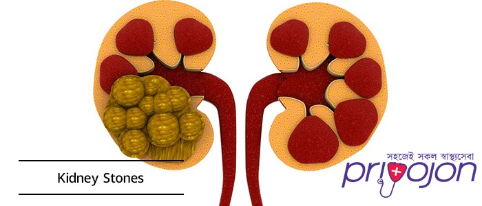 kidney-stones-symptom-causes-treatment-diet-and-removal