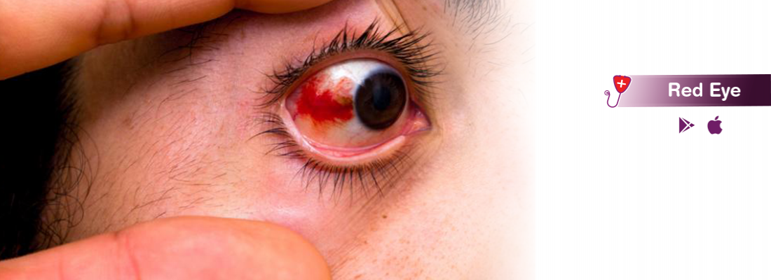 red-eyes-treatment-procedure-cost-and-side-effects