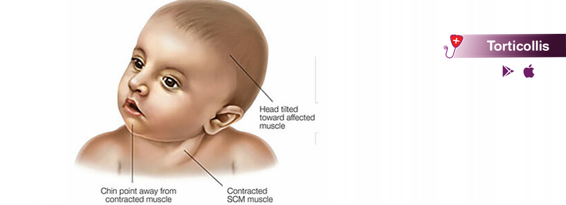 Torticollis