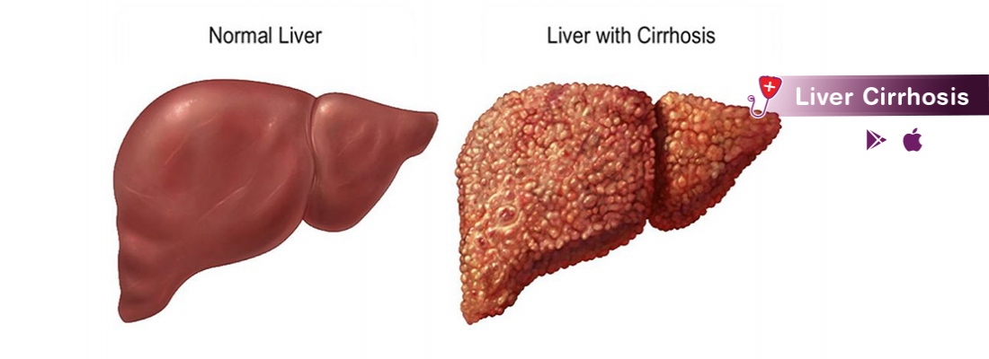 cirrhosis-symptom-treatment-and-causes