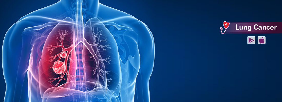 all-you-need-to-know-about-lung-cancer