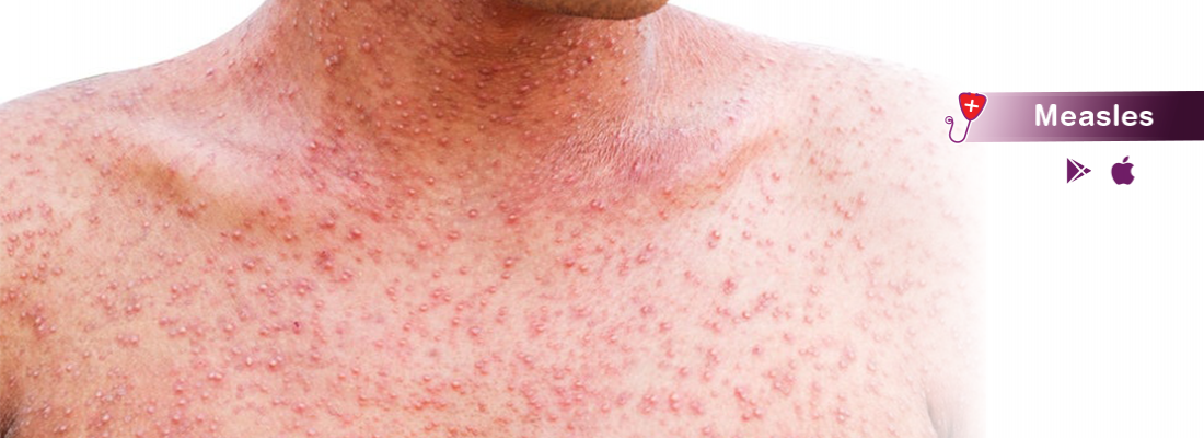 measles-symptom-treatment-and-causes