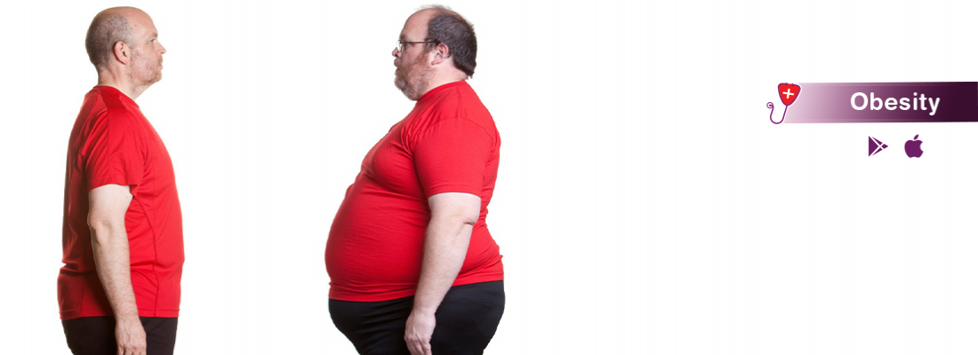 obesity-symptom-treatment-and-causes